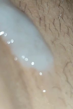 Scrotal Phimosis Results in an Extremely Hot Orgasm.