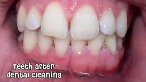 Teeth after dental cleaning
