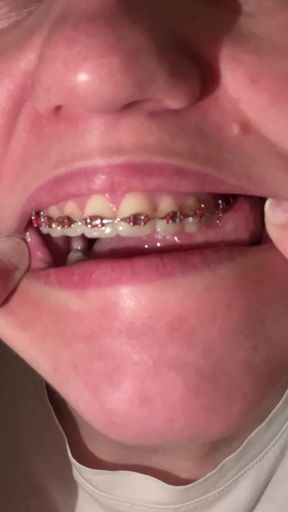 Licking Your Braces with Your Tongue