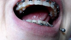 braces and pierced tongue close up