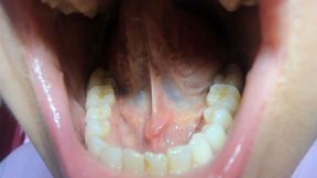 Large tongue salivary calculus avi