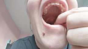 Big tonsil stones mine