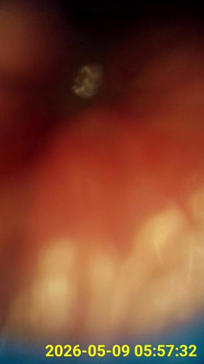 Close up of buttplug &amp; HD Endoscope insertion