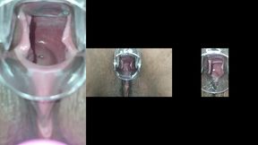 especulo anal