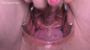 close up urethra & cervix prolapse
