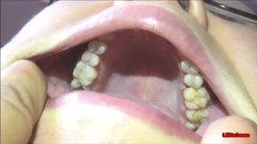 Upper teeth [LINDA],