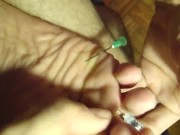 needle on my soles & between toes