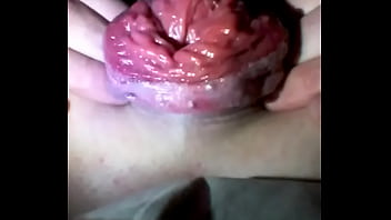 Anal prolapse