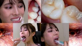 Tsubaki Hanai - Observing Tsubaki's teeth, mouth, and back of the throat with a dental camera