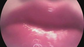 spit bubbles- endoscope view