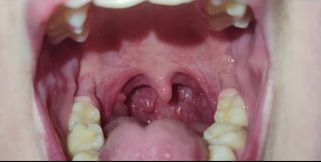 A Close-up of My Throat