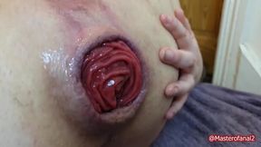 Punch Fisting Huge Pussy And Ass Till They Prolapse