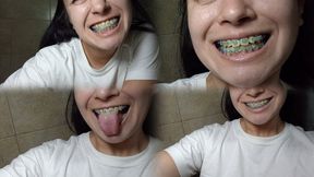 Close-up of yellow teeth with braces