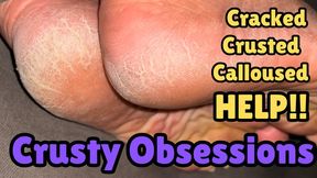 Crusty Obsession Closeup | CRACKED Heels Worship Chipped Polish Toes