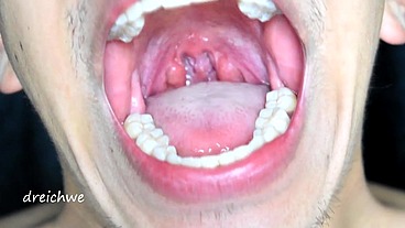 Large uvula and hot