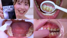 Yuzu Fujita - Observing Yuzu's teeth with a dental mirror & brushing her teeth while wearing a mouth opener & finger toothbrushing while wearing a lip hook