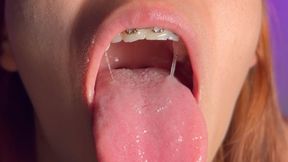 Braces Mouth Fetish