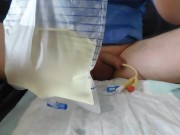 bladder lavage, 3-way catheter