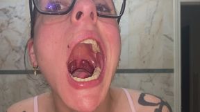 Tonsil extraction