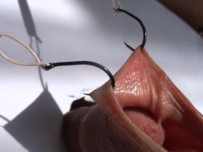 fishhooks in foreskin