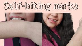 Self-biting marks: forearm, hand and fingers