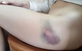 Margot Pees with a Big Bruise on Her Leg