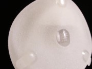 Gradual filling of expander breast implant with saline into twice its prescribed size