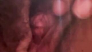 Post Op Meta FTM (Not lounging) Pouch Pending…