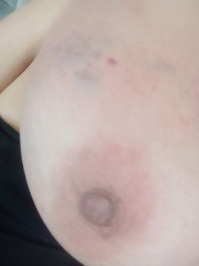Bruised breasts