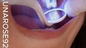LET’S DO A MOUTH TOUR! LETS GO OVER MY DENTAL HISTORY! DID YOU KNOW I HAVE SILVER AMALGAM FILLINGS!?