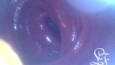Anal Endoscope all the way in my Transverse Colon!