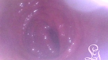 Anal Endoscope all the way in my Transverse Colon!