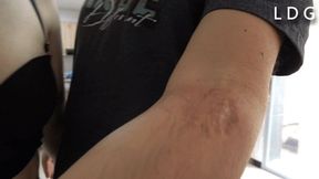 Alison Biting Walking And Leaving Big Marks