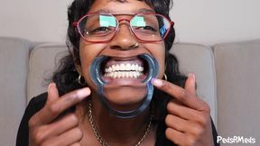 YourOnlyPhoenix Dental Retractor Mouth Tour