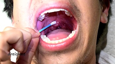 Touching the uvula with swabs