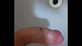 Pauz&atilde_o com fimose