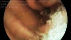 Medical exam in hospital video of medical endoscopy in full screen 720wmv