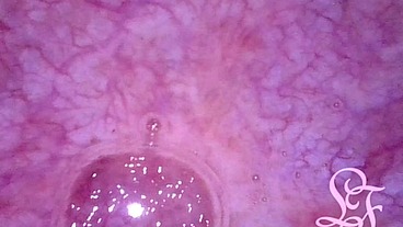 POV Endoscope Catheter Bladder Inflation!