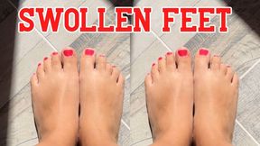 Swollen feet