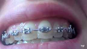 My teeth in brazes to cam mp