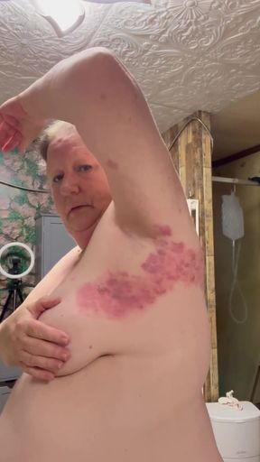 Bad Case of Shingles