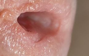 Enlargement of the Deep Urethral Hole!!