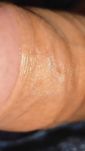 Difficult Fluid Control Due to Straight Phimosis.