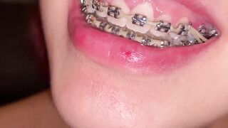 SLUTS WITH BRACES SHOWS HER MOUTH INTO ASMR