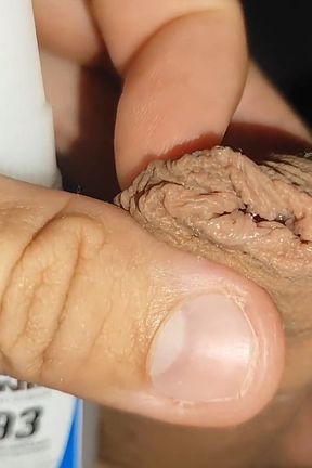 Super Glue, Gluing the Phimosis Leather on the Glans!