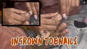 Ingrown nails + painting