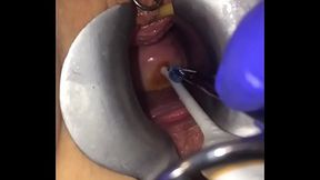 Cervix extreme gyno play