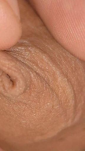 Large Healed Phimosis Holds the Cock Head.