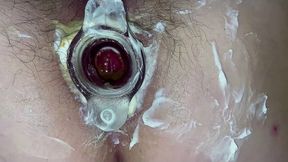 Hot Anal gaping & tunnel plug. Hairy cunt & asshole close-up