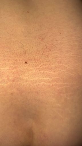 Close-up of a person's back with a mole